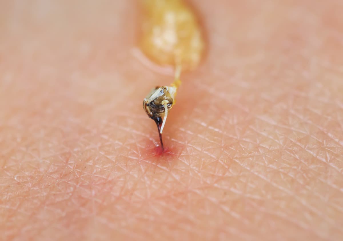 A honeybee's barbed sting left in skin