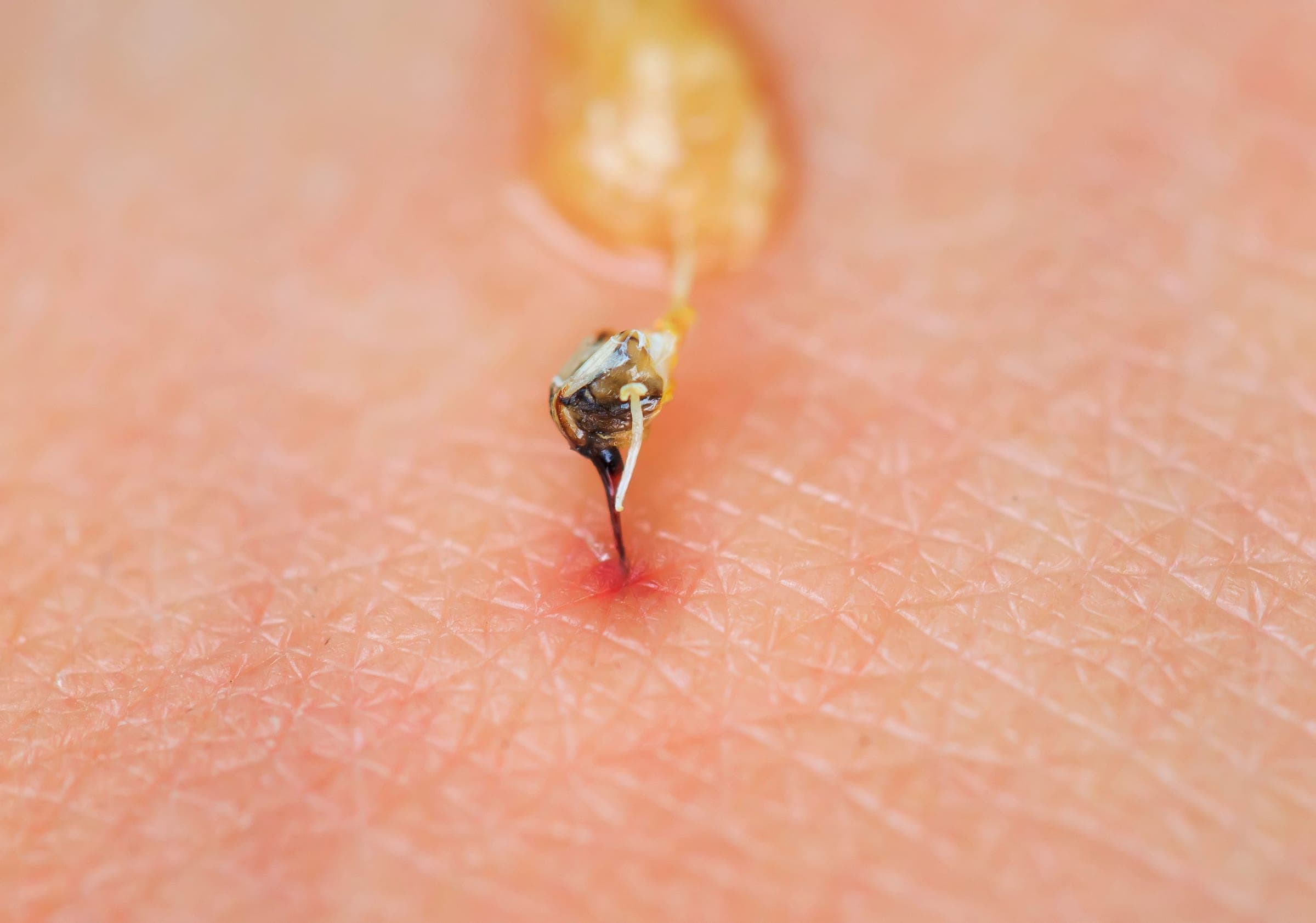 A honeybee's barbed sting left in skin